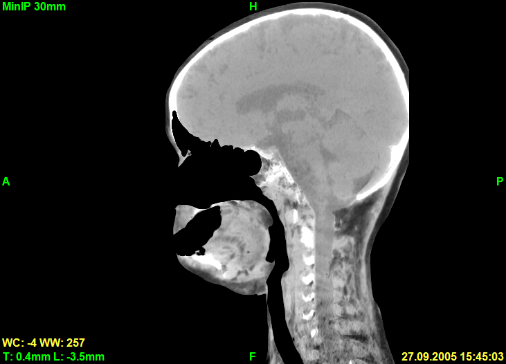 Screenshot of sagittal slice in MinIP rendering mode